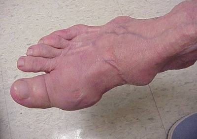 Tìm hiểu về nguyên nhân, triệu chứng gây bệnh gout, trieu chung nhan biet benh gout